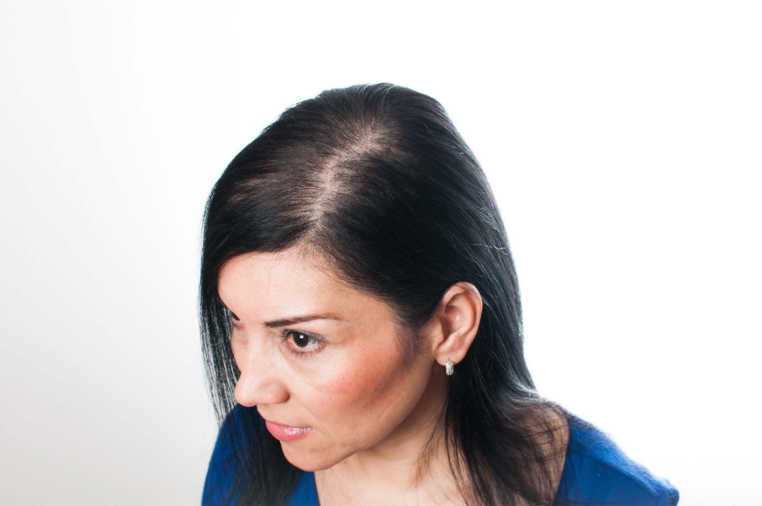 haaruitval haaruitval